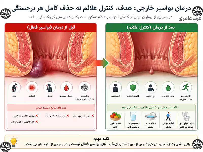 اینفوگرافیک درمان خانگی بواسیر خارجی؛ مقایسه بواسیر فعال قبل از درمان با وضعیت پس از کنترل علائم، کاهش درد و التهاب، همراه با نقش فیبر، آب کافی، حمام سیتز و فعالیت بدنی در بهبود بیماری
