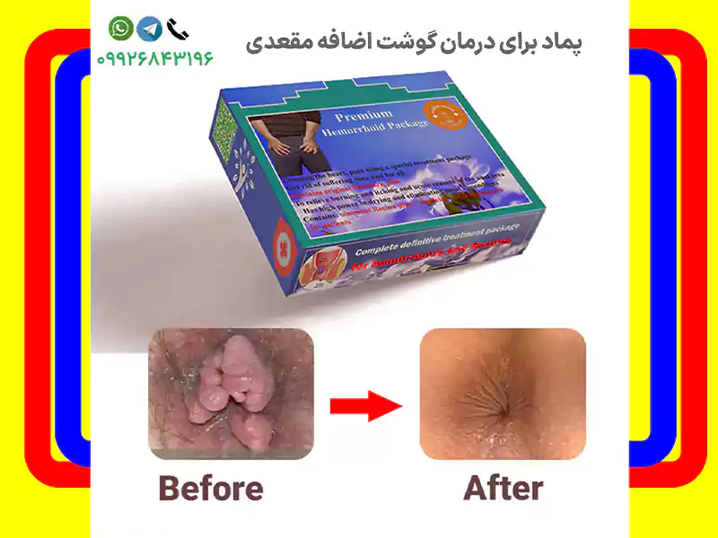 آیا گوشت اضافه مقعدی با پماد از بین میرود؟
