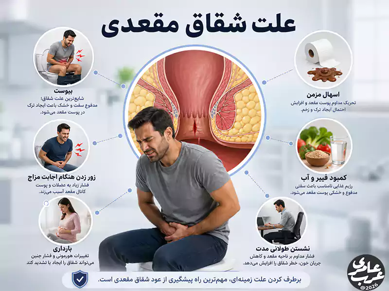 علت شقاق مقعدی