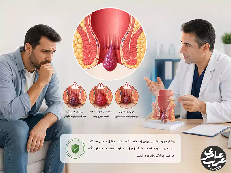 آیا بواسیر بیرون زده خطرناک است؟ بیشتر موارد بواسیر بیرون زده خطرناک نیستند