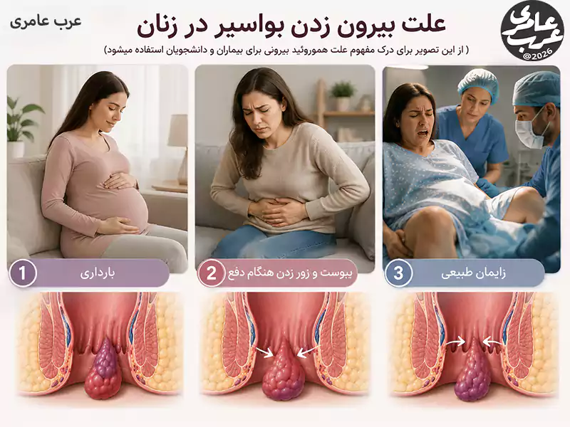 بارداری یکی از مهمترین دلایل بیرون زدگی بواسیر در زنان است.