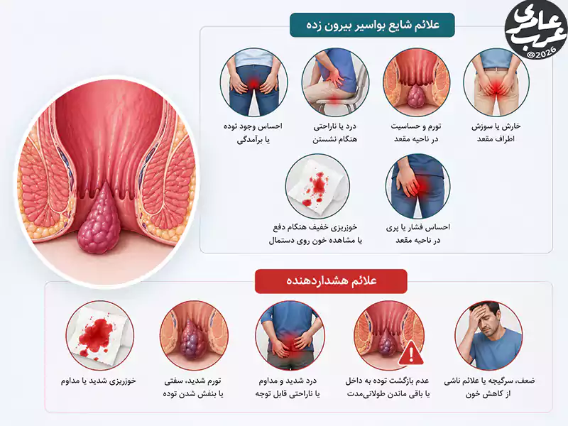 علائم شایع بواسیر بیرون زده