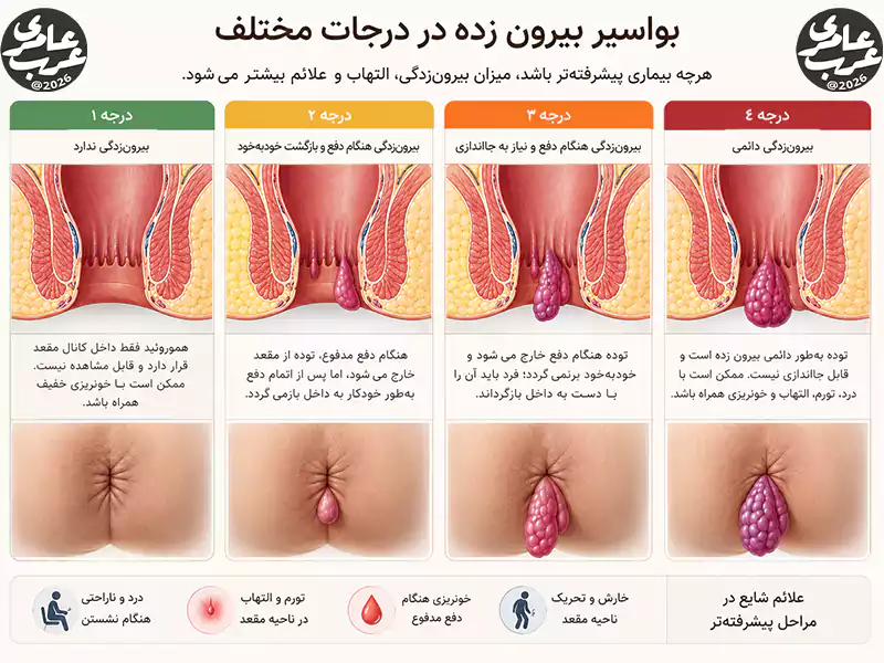 تصویر آموزشی و شماتیک درجات مختلف بواسیر بیرون زده که مراحل پیشرفت پرولاپس هموروئید را از بیرونزدگی موقت هنگام دفع تا بیرونزدگی دائمی نشان میدهد و به درک تفاوت ظاهر بواسیر در مراحل مختلف بیماری کمک میکند.