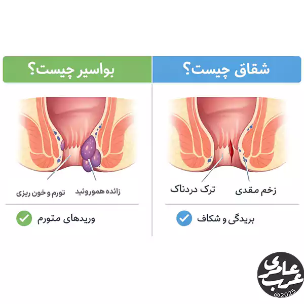بواسیر و شقاق