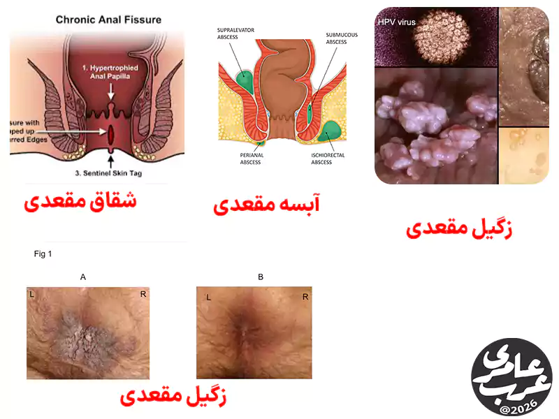 مشاهده عکس بواسیر خارجی همیشه برای تشخیص قطعی کافی نیست. برخی بیماریهای مقعدی ظاهر مشابهی دارند. افتراق صحیح از خطای درمانی جلوگیری میکند.
