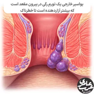 بواسیر خارجی در زبان ساده یعنی ورم کردن رگهای اطراف دهانه مقعد.
