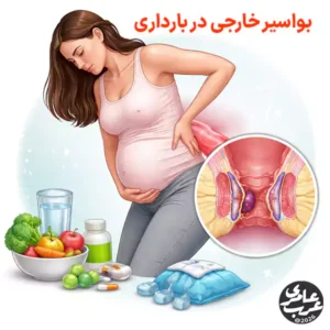 بواسیر خارجی در بارداری یکی از شایعترین مشکلات ناحیه مقعد در سهماهه دوم و سوم است.