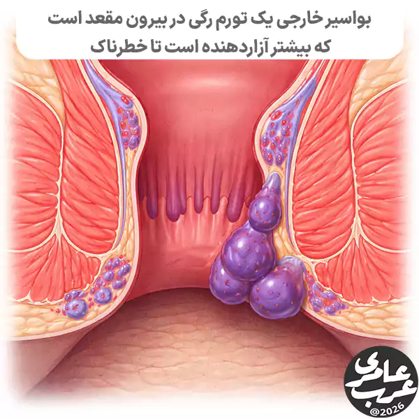 بواسیر خارجی در زبان ساده یعنی ورم کردن رگهای اطراف دهانه مقعد.