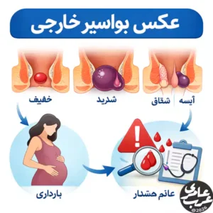 عکس بواسیر خارجی یکی از پرتکرارترین جستجوها در میان افرادی است؛ که با تورم یا درد مقعدی مواجه میشوند