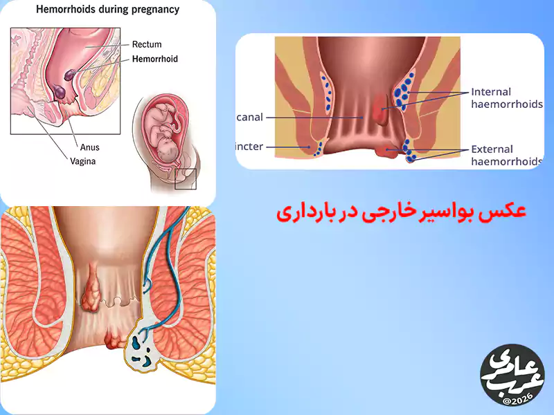 در عکس بواسیر خارجی در بارداری معمولاً تورم نرم یا نیمهسفت در اطراف مقعد مشاهده میشود