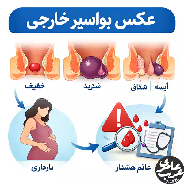 عکس بواسیر خارجی یکی از پرتکرارترین جستجوها در میان افرادی است؛ که با تورم یا درد مقعدی مواجه میشوند