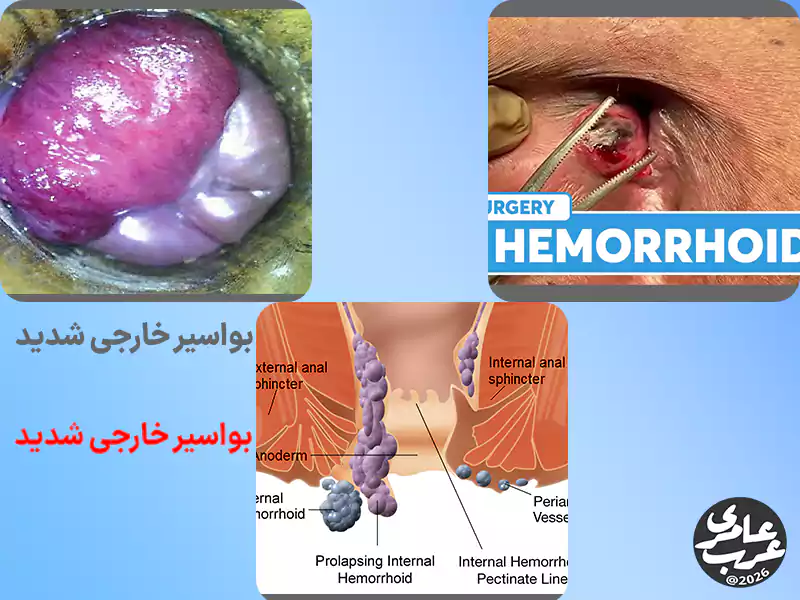 در عکس بواسیر خارجی شدید تورم واضح و بزرگ مشاهده میشود. ضایعه ممکن است سفت و به رنگ بنفش یا آبی تیره باشد. این تغییر رنگ معمولاً نشانه ترومبوز است.