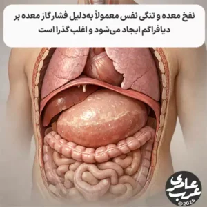 نفخ معده و تنگی نفس از علائمی است که میتواند بهطور ناگهانی ایجاد شود؛ و نگرانی جدی بههمراه داشته باشد. بسیاری از بیماران هنگام احساس فشار شکمی و دشواری در تنفس، احتمال مشکلات قلبی یا ریوی را مطرح میکنند