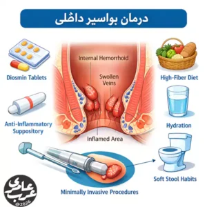 مسیر درمان بواسیر داخلی بصورت مرحله به مرحله و عملی