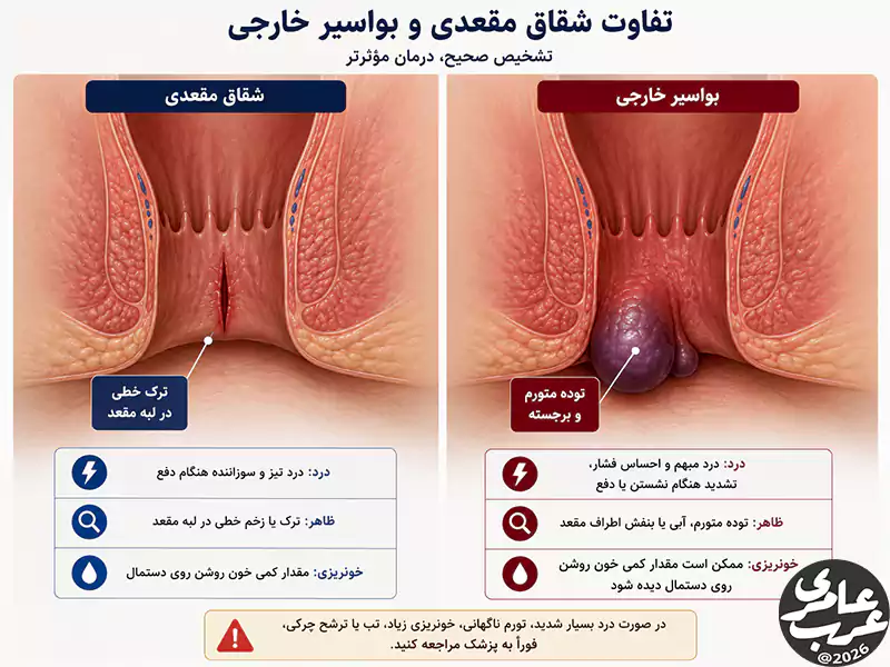 مقایسه شقاق مقعدی و بواسیر خارجی؛ نمایش تفاوت ظاهری ترک مقعد و توده متورم هموروئیدی