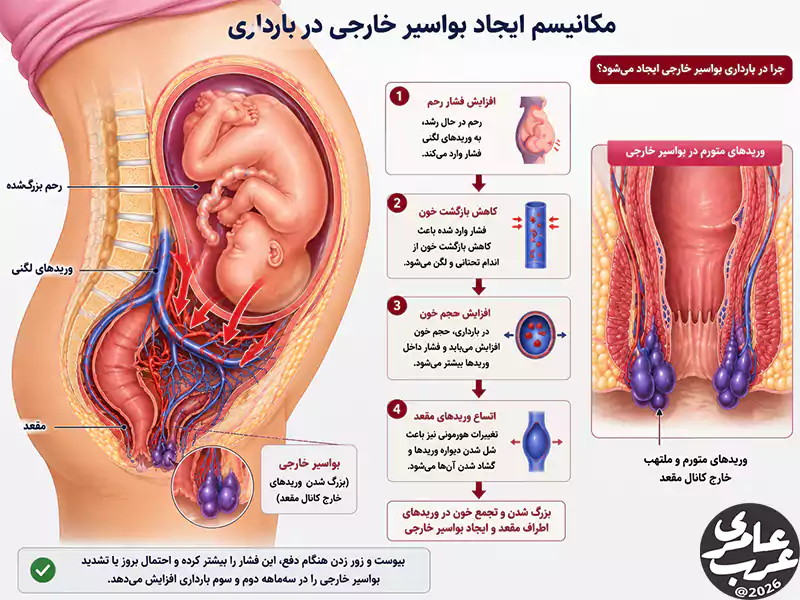 نمای آناتومیک مکانیسم ایجاد بواسیر خارجی در بارداری و تأثیر فشار رحم بر وریدهای لگنی و مقعد