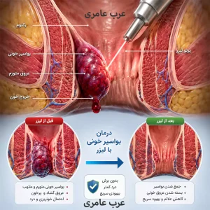 درمان بواسیر خونی با لیزر یا جراحی