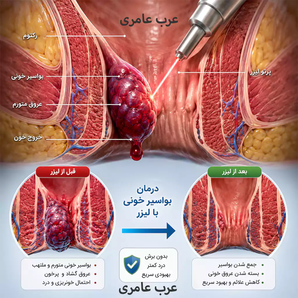 درمان بواسیر خونی با لیزر یا جراحی