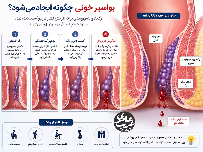 تصویر آموزشی نحوه ایجاد بواسیر خونی و خونریزی رگهای هموروئیدی در کانال مقعد