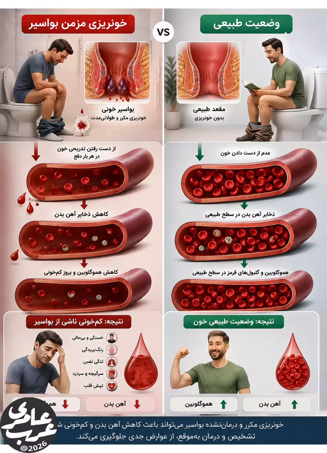 مقایسه سهبعدی خونریزی مزمن بواسیر و تأثیر آن بر کاهش آهن، افت هموگلوبین و بروز کمخونی