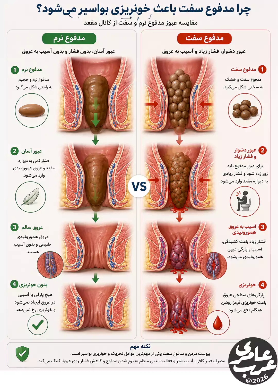 مقایسه عبور مدفوع سفت و نرم و تأثیر آن بر خونریزی عروق هموروئیدی در بواسیر خونی
