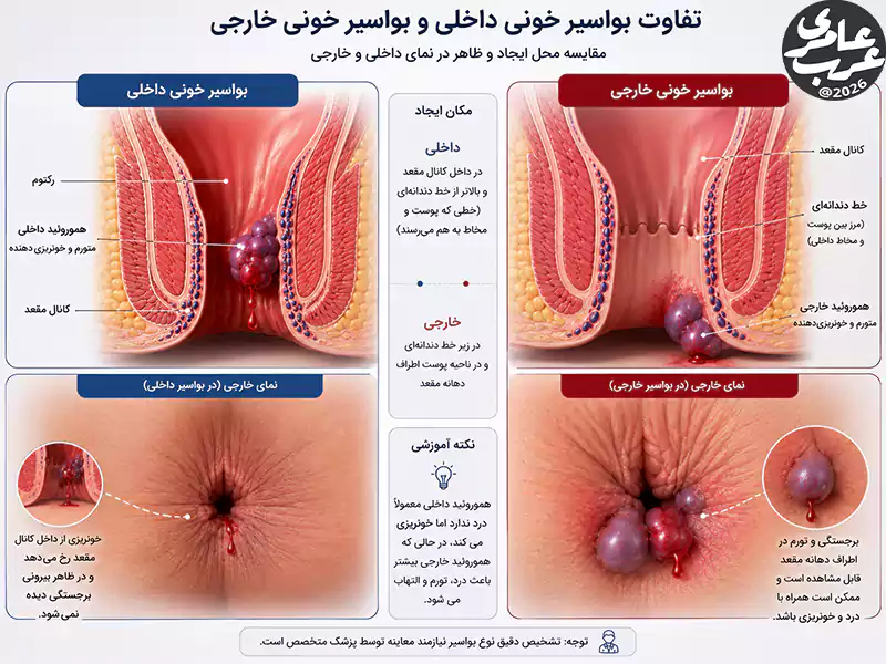 مقایسه آناتومیک بواسیر خونی داخلی و بواسیر خونی خارجی با نمایش محل ایجاد، ظاهر و الگوی خونریزی