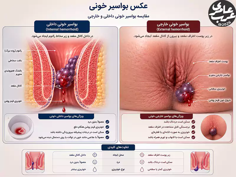 مقایسه تصویری بواسیر خونی داخلی و بواسیر خونی خارجی همراه با محل ایجاد، ظاهر و نحوه خونریزی