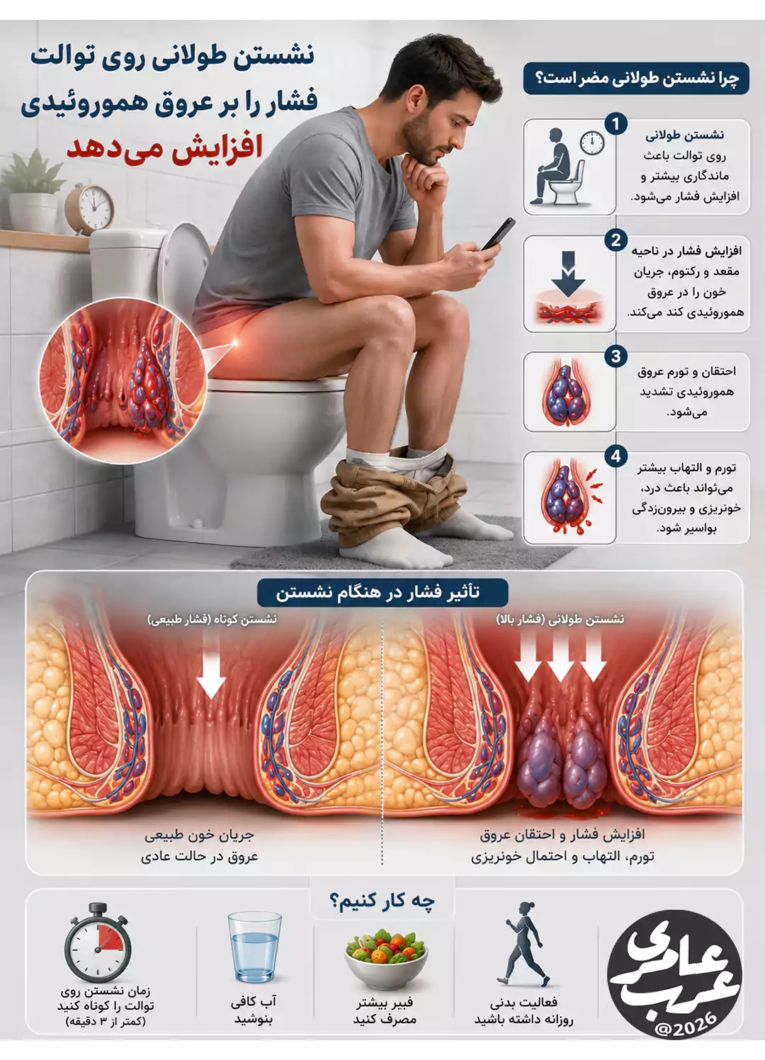 تصویر سهبعدی تأثیر نشستن طولانی روی توالت و افزایش فشار بر عروق هموروئیدی