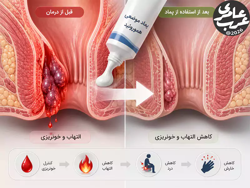 تأثیر پماد موضعی بر کاهش التهاب و خونریزی بواسیر خونی