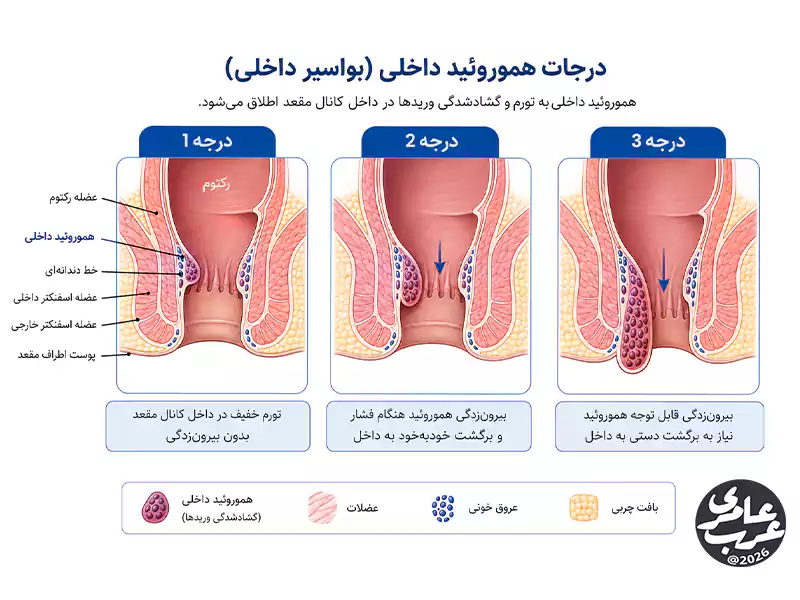علائم بواسیر داخلی معمولاً بهصورت تدریجی پیشرفت میکنند و شدت آنها با افزایش فشار و التهاب وریدی بیشتر میشود.