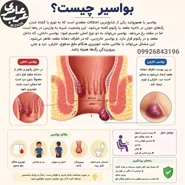 بواسیر یا هموروئید یکی از شایعترین اختلالات مقعدی است که به تورم یا گشاد شدن رگهای خونی در ناحیه مقعد یا رکتوم گفته میشود.