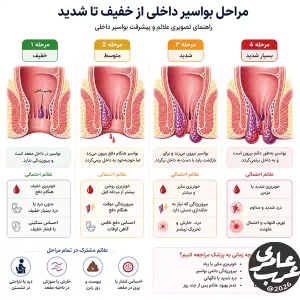 علائم بواسیر داخلی از حالت خفیف و بدون درد به وضعیت شدید و آزاردهنده تبدیل میشود.
