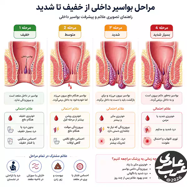 علائم بواسیر داخلی از حالت خفیف و بدون درد به وضعیت شدید و آزاردهنده تبدیل میشود.