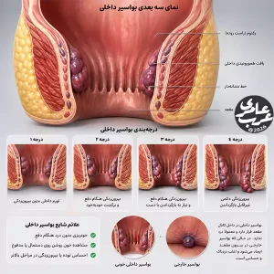 عکس بواسیر داخلی